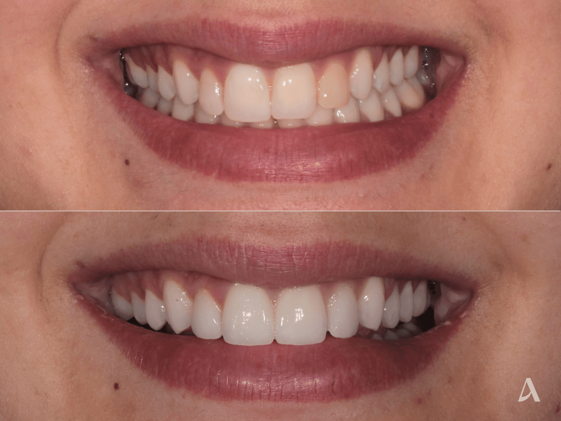 Porcelain Veneers – 1 month – ArtSmiles Gold Coast