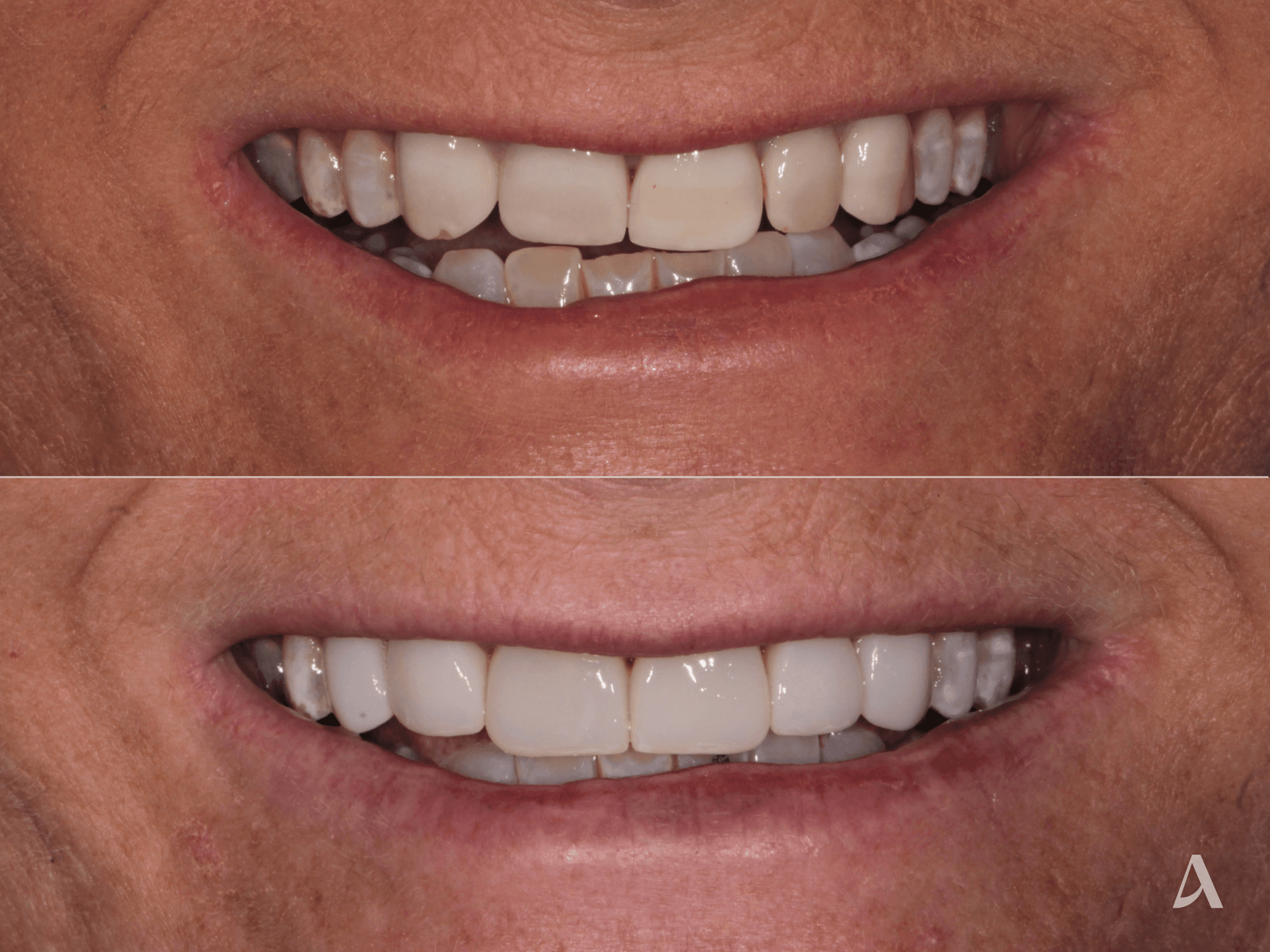 Porcelain Veneers – 1 month – ArtSmiles Gold Coast