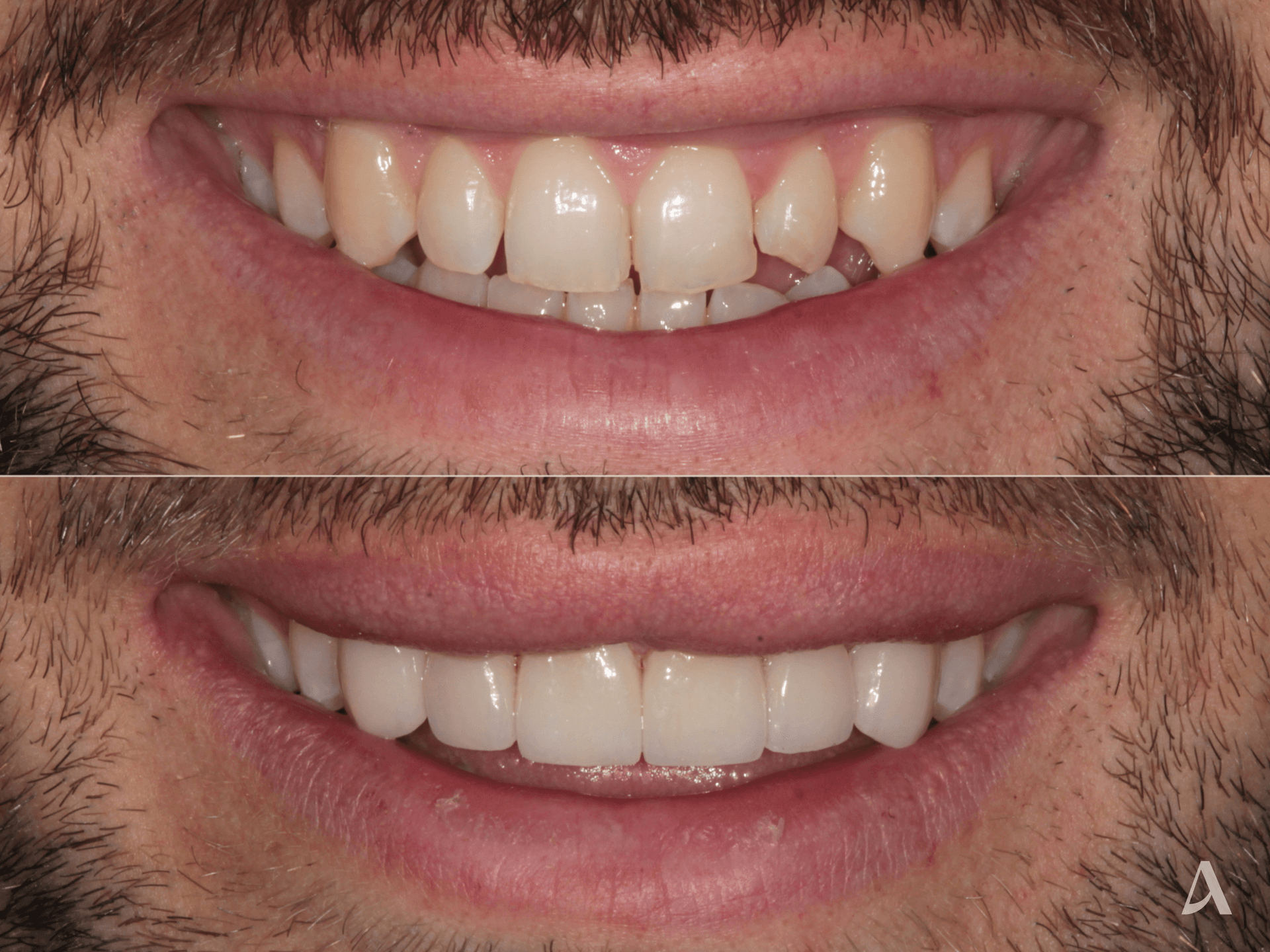 Porcelain Veneers – 1 month – ArtSmiles Gold Coast