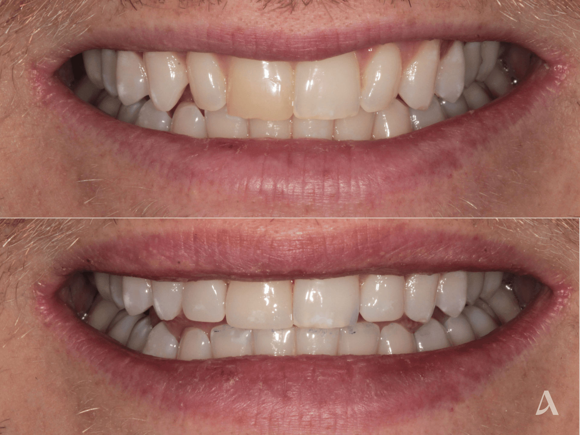 Porcelain Veneers – 2 months – ArtSmiles Gold Coast