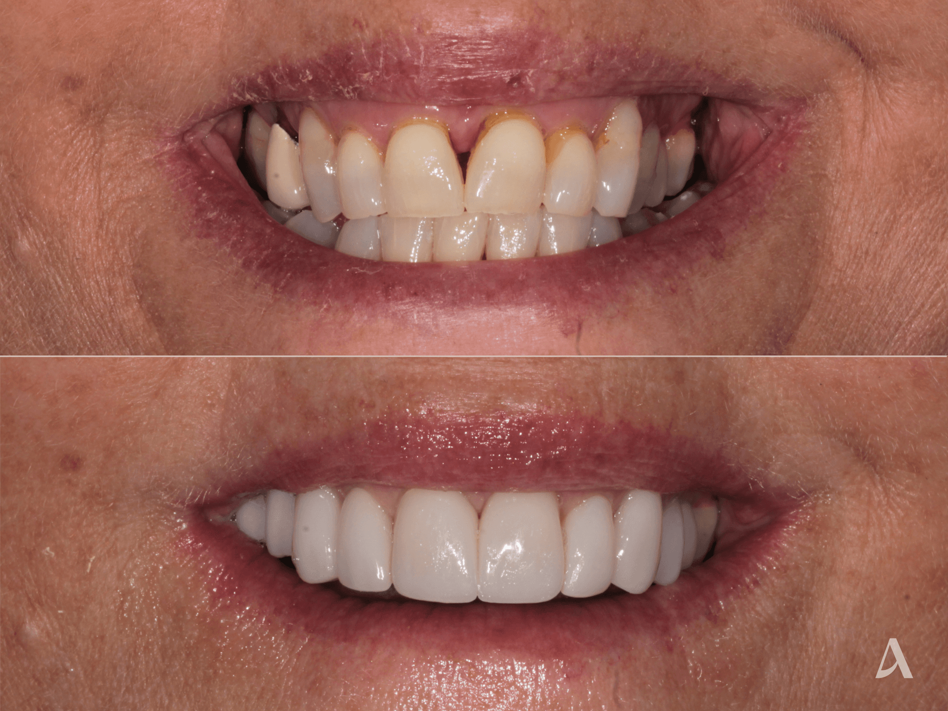 Porcelain Veneers – 2 months – ArtSmiles Gold Coast