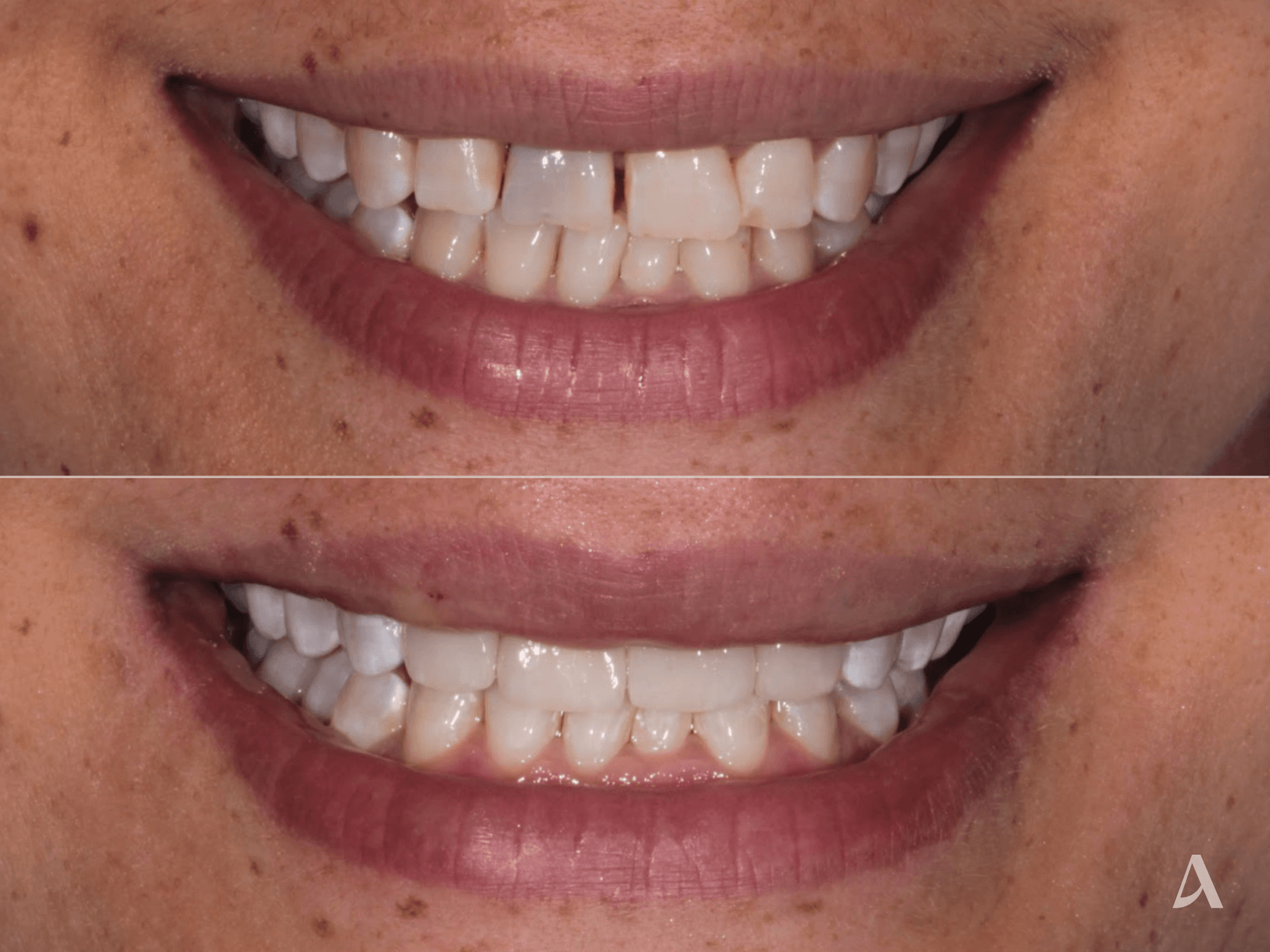 Porcelain Veneers, Crown & Bridge – 1 month – ArtSmiles Gold Coast