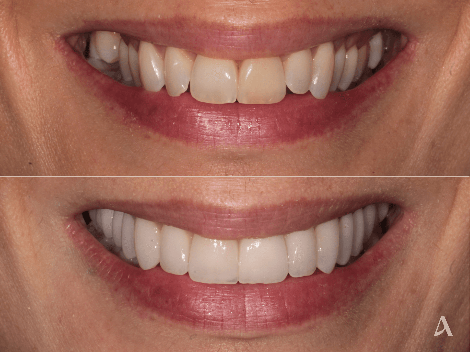 Porcelain Veneers, Crown & Bridge – 2 months – ArtSmiles Gold Coast