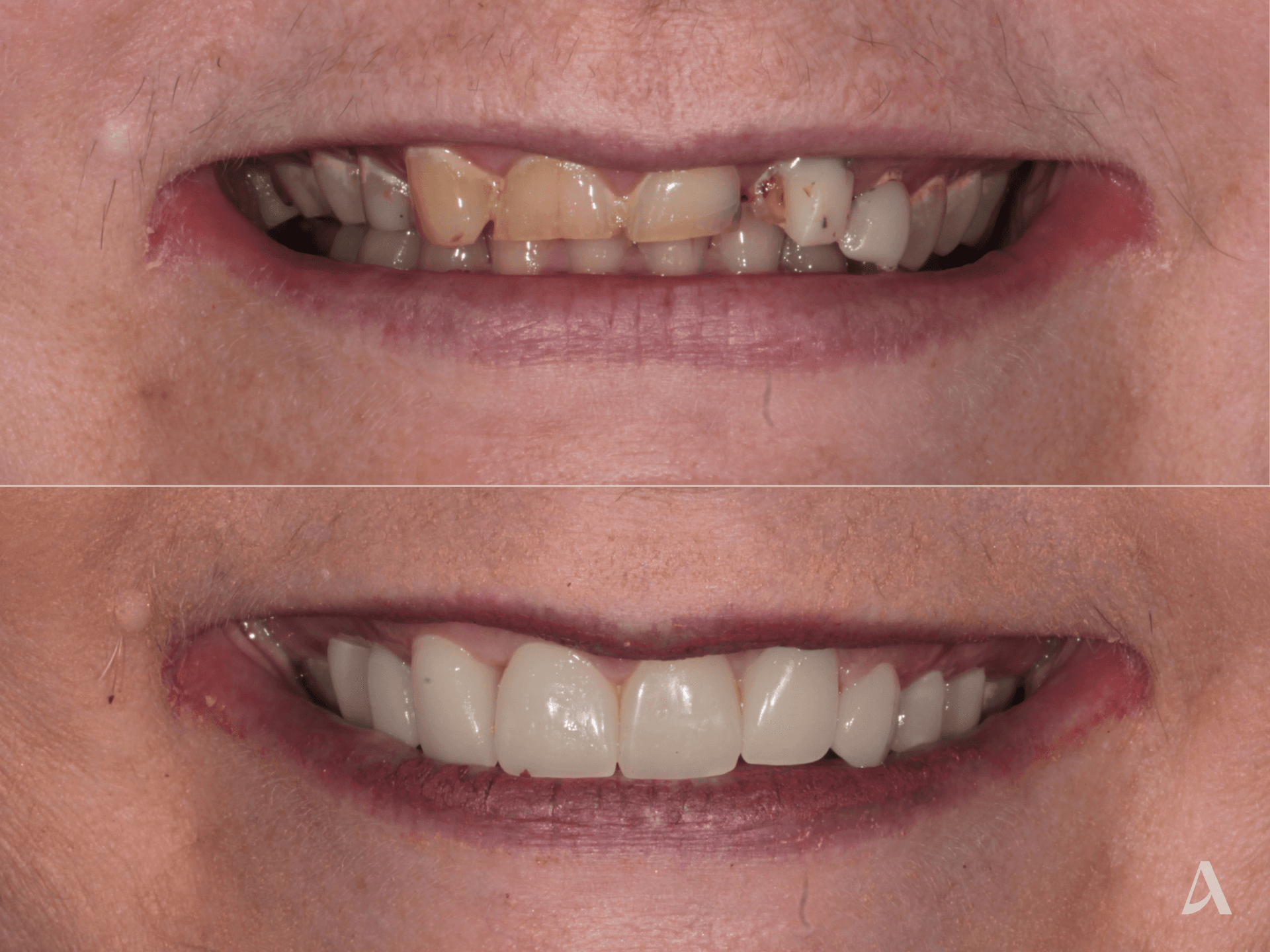 Porcelain Veneers, Crown & Bridge – 4 months – ArtSmiles Gold Coast