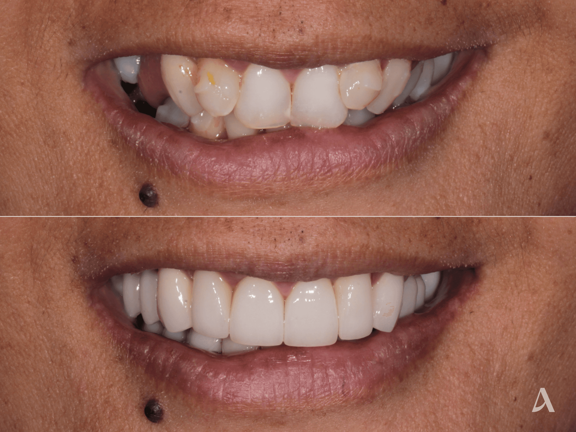 Porcelain Veneers, Crown & Bridge, Complex Rehabilitation, Implant – 9 months – ArtSmiles Gold Coast