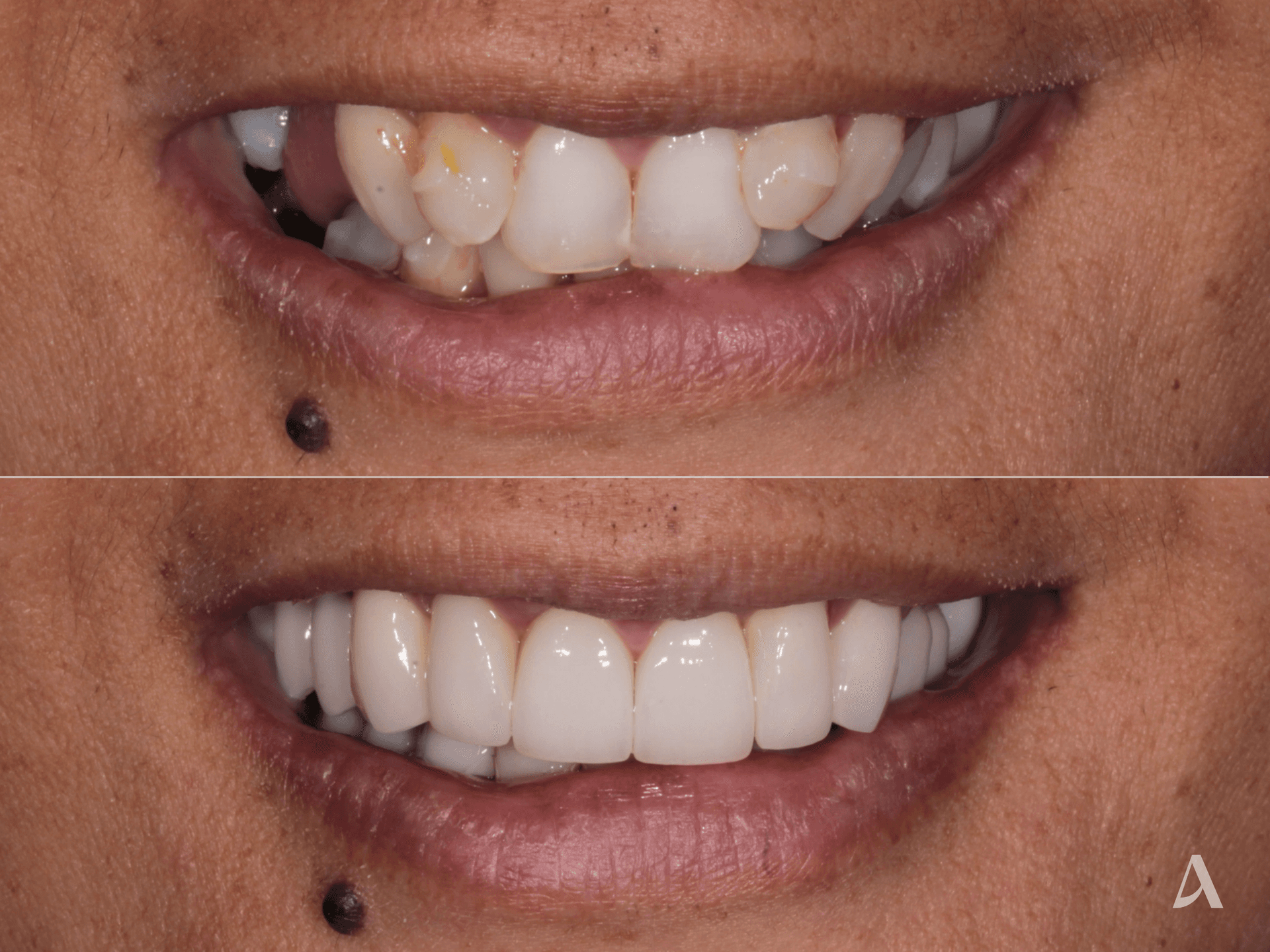 Porcelain Veneers, Implant, Crown & Bridge, Complex Rehabilitation – 10 months – ArtSmiles Gold Coast