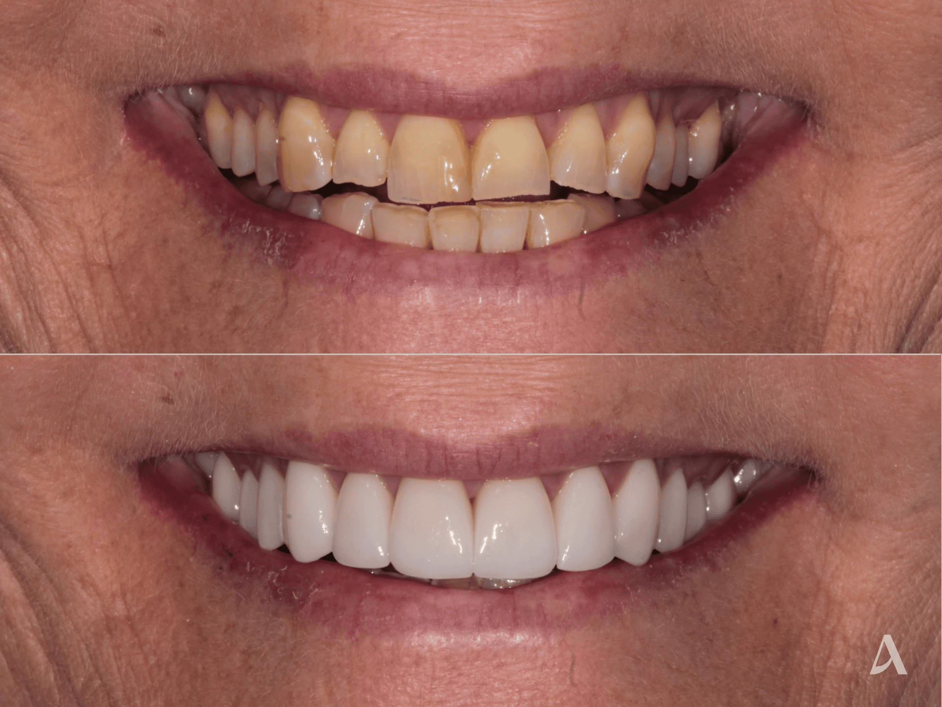 Porcelain Veneers, Increase Vertical Dimension – 2 months – ArtSmiles Gold Coast