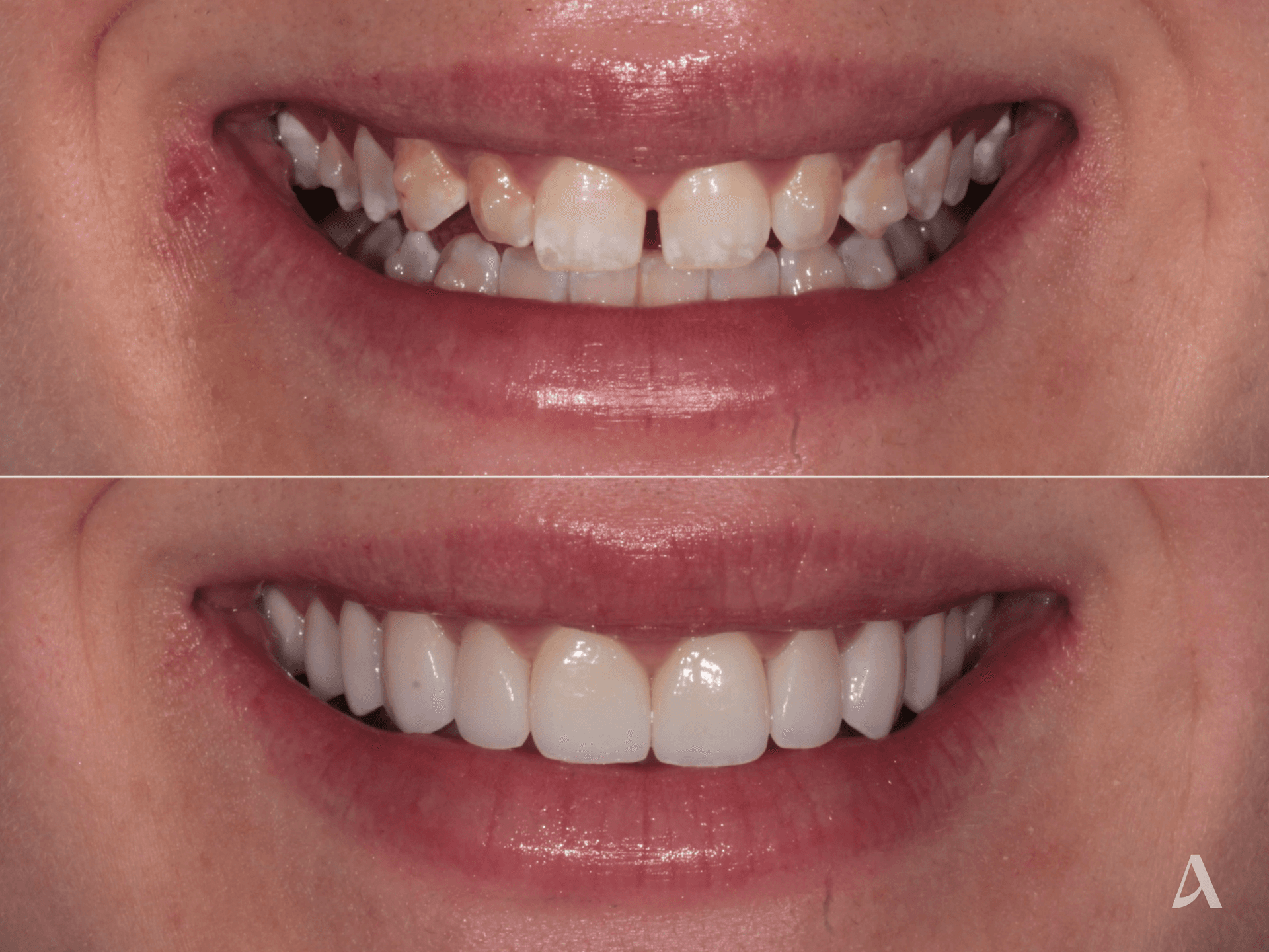 Zirconia Veneers – 1 month – ArtSmiles Gold Coast