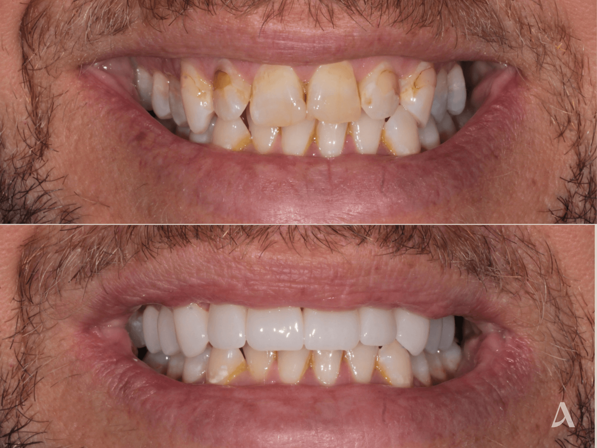 Zirconia Veneers – 1 month – ArtSmiles Gold Coast