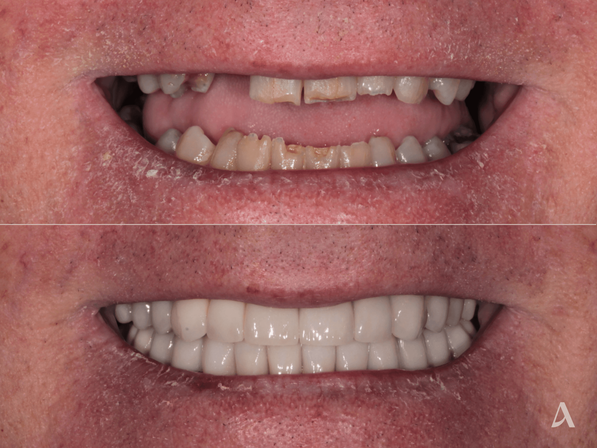 Zirconia Veneers, Complex Rehabilitation, Crown & Bridge – 2 months – ArtSmiles Gold Coast