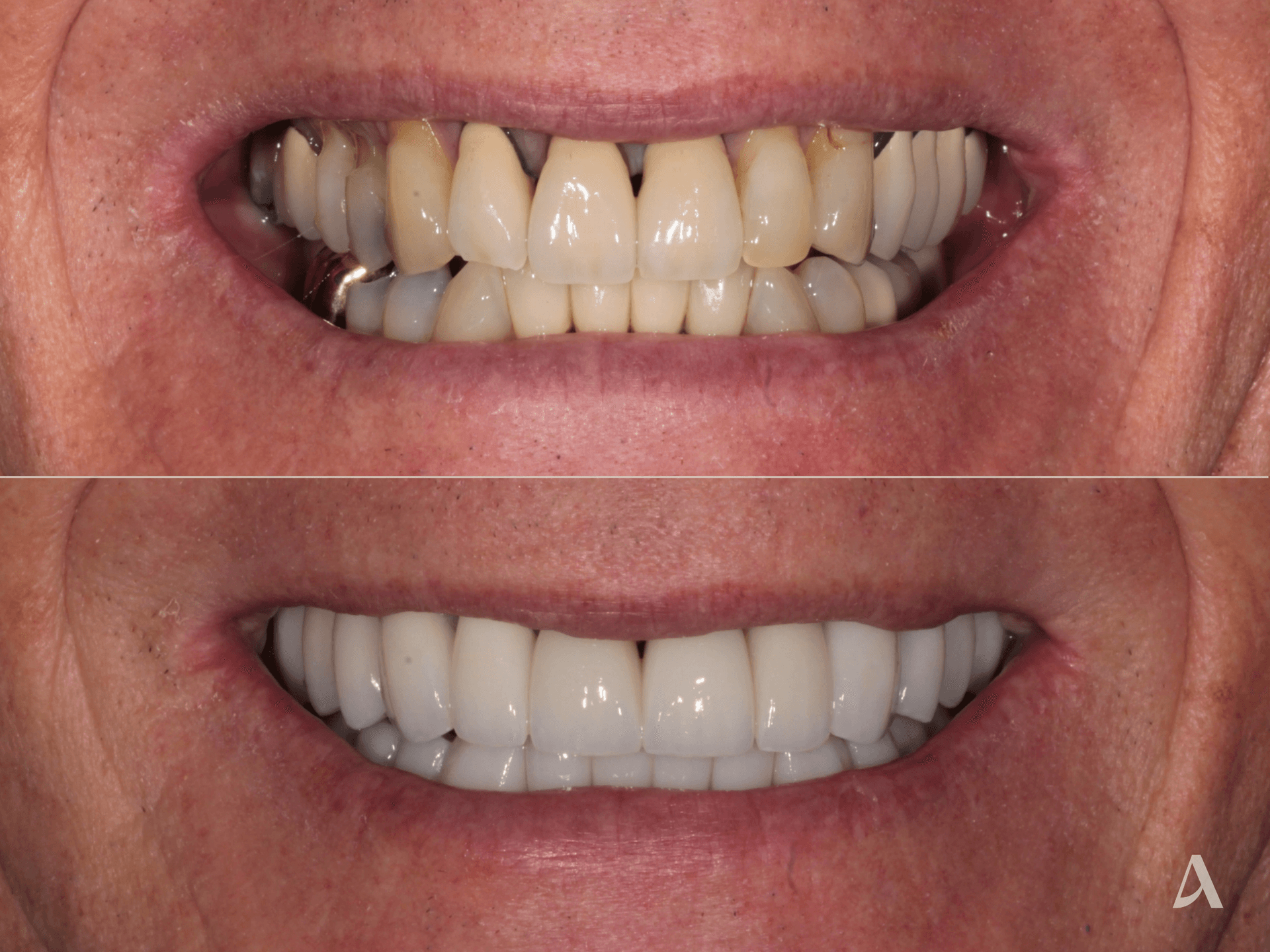 Zirconia Veneers, Complex Rehabilitation, Crown & Bridge – 3 months – ArtSmiles Gold Coast