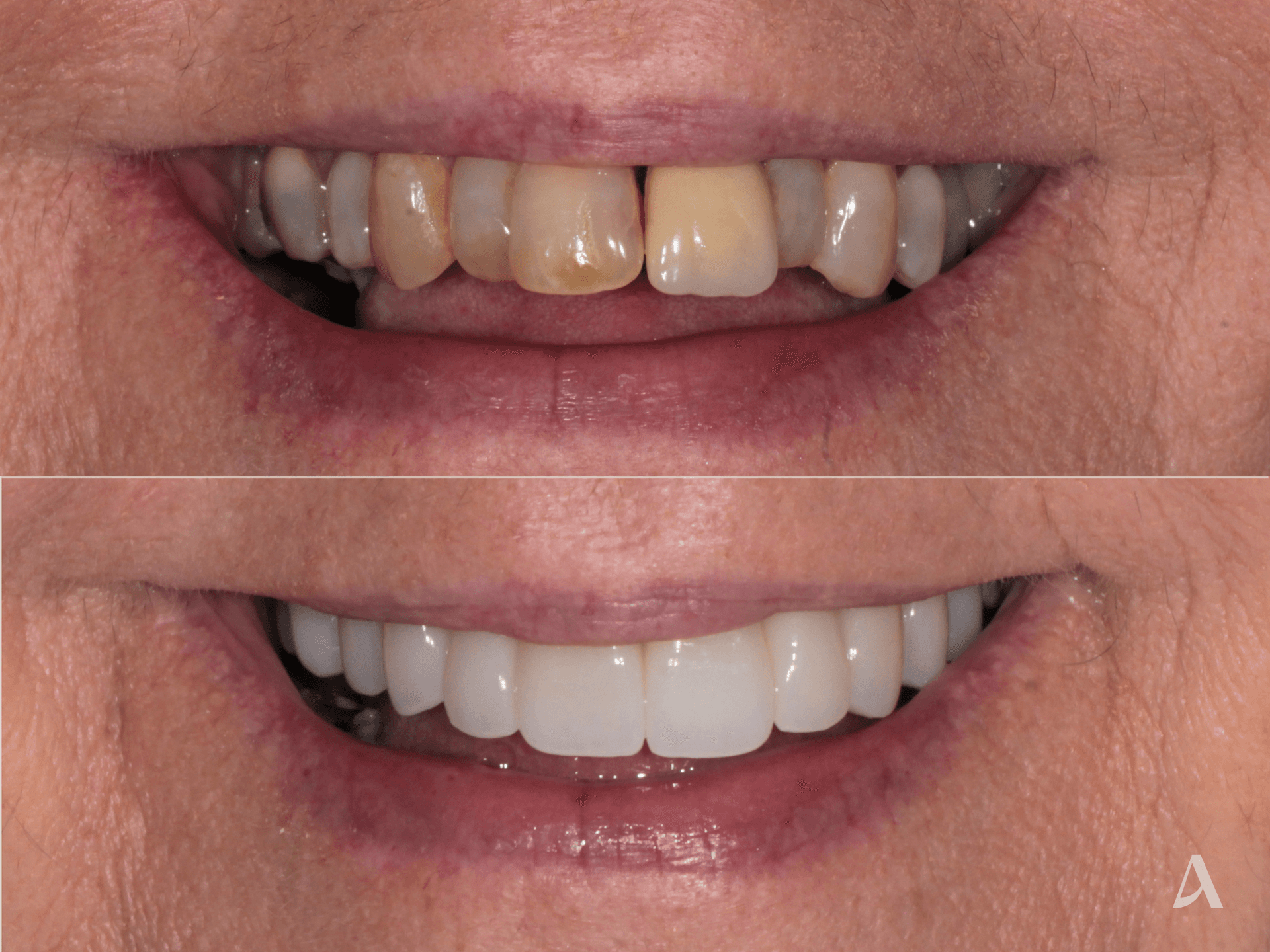 Zirconia Veneers, Complex Rehabilitation, Gum Disease – 2 months – ArtSmiles Gold Coast