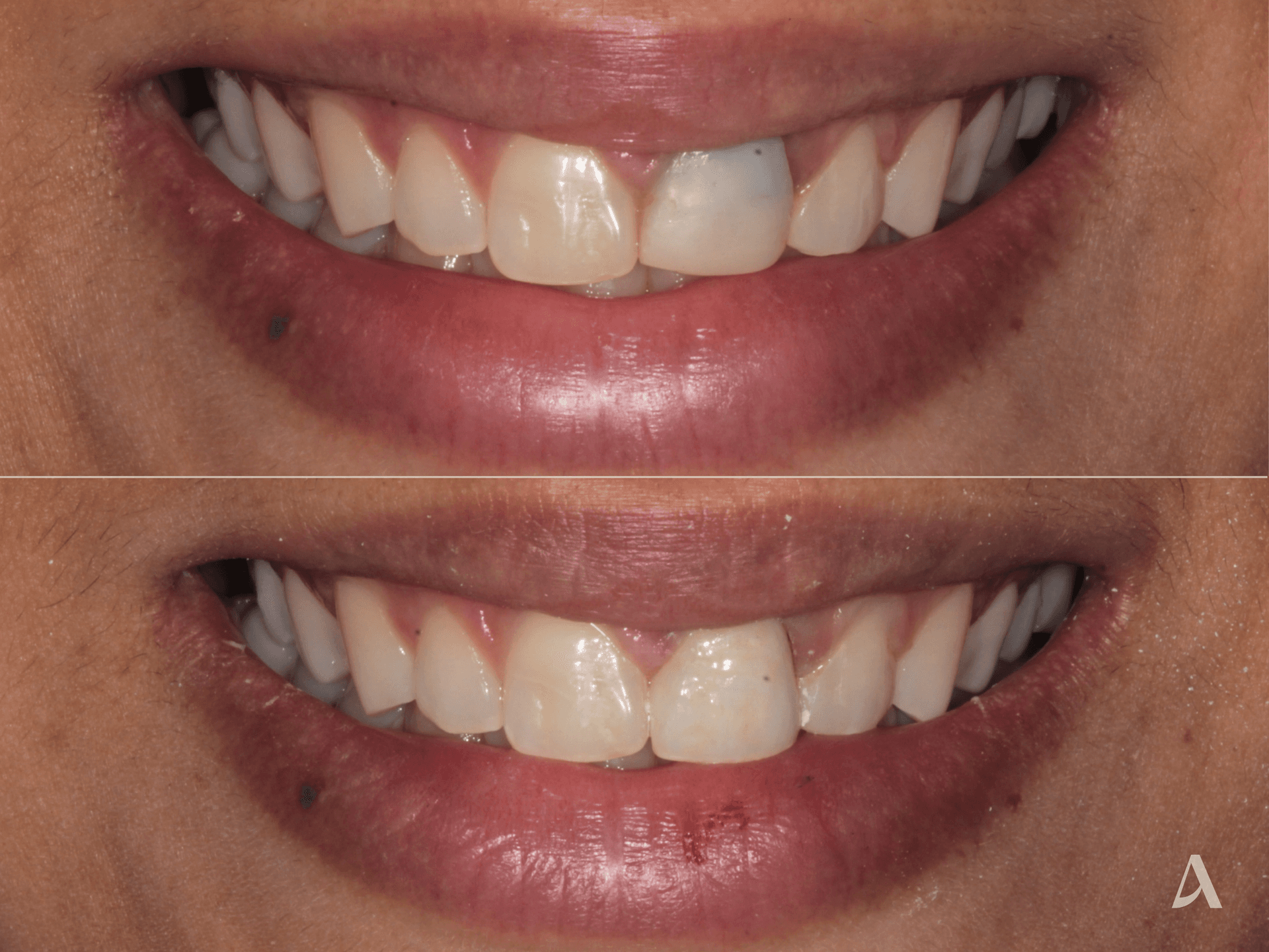 Zirconia Veneers, Crown & Bridge – 1 month – ArtSmiles Gold Coast