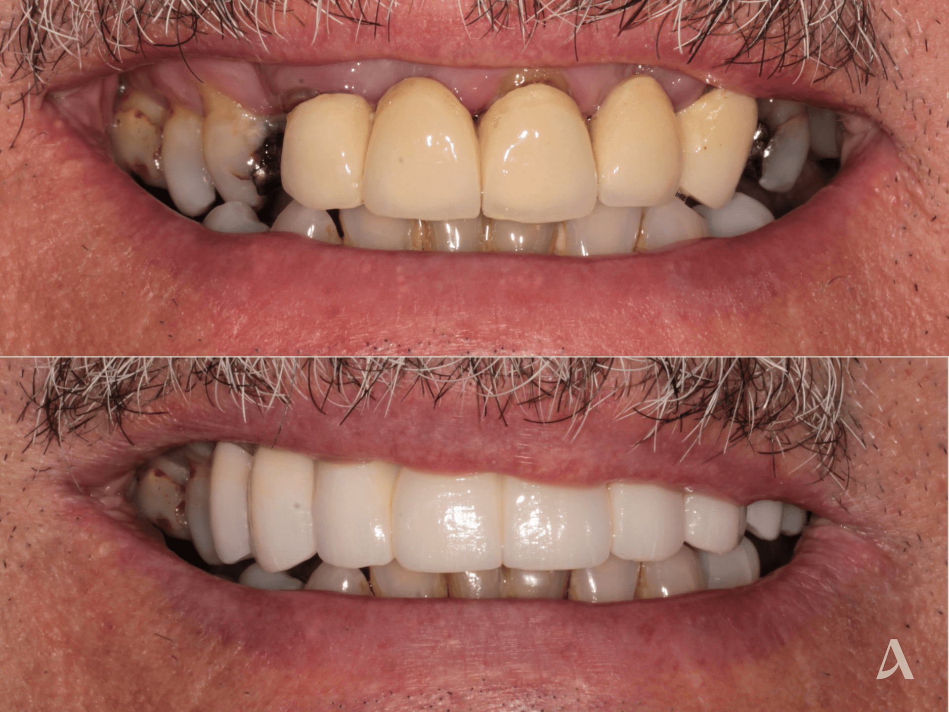 Zirconia Veneers, Crown & Bridge – 1 month – ArtSmiles Gold Coast