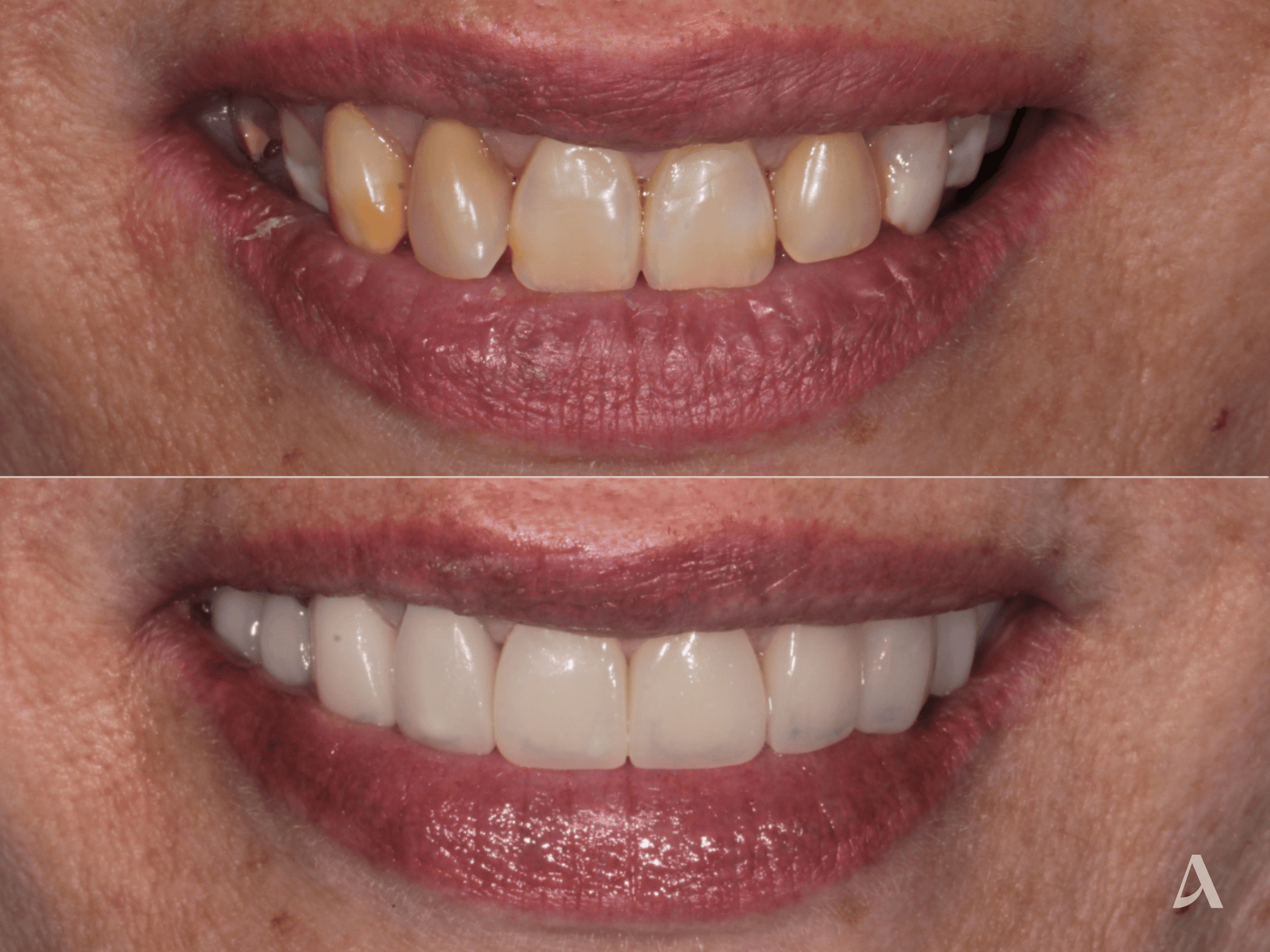 Zirconia Veneers, Crown & Bridge – 3 months – ArtSmiles Gold Coast