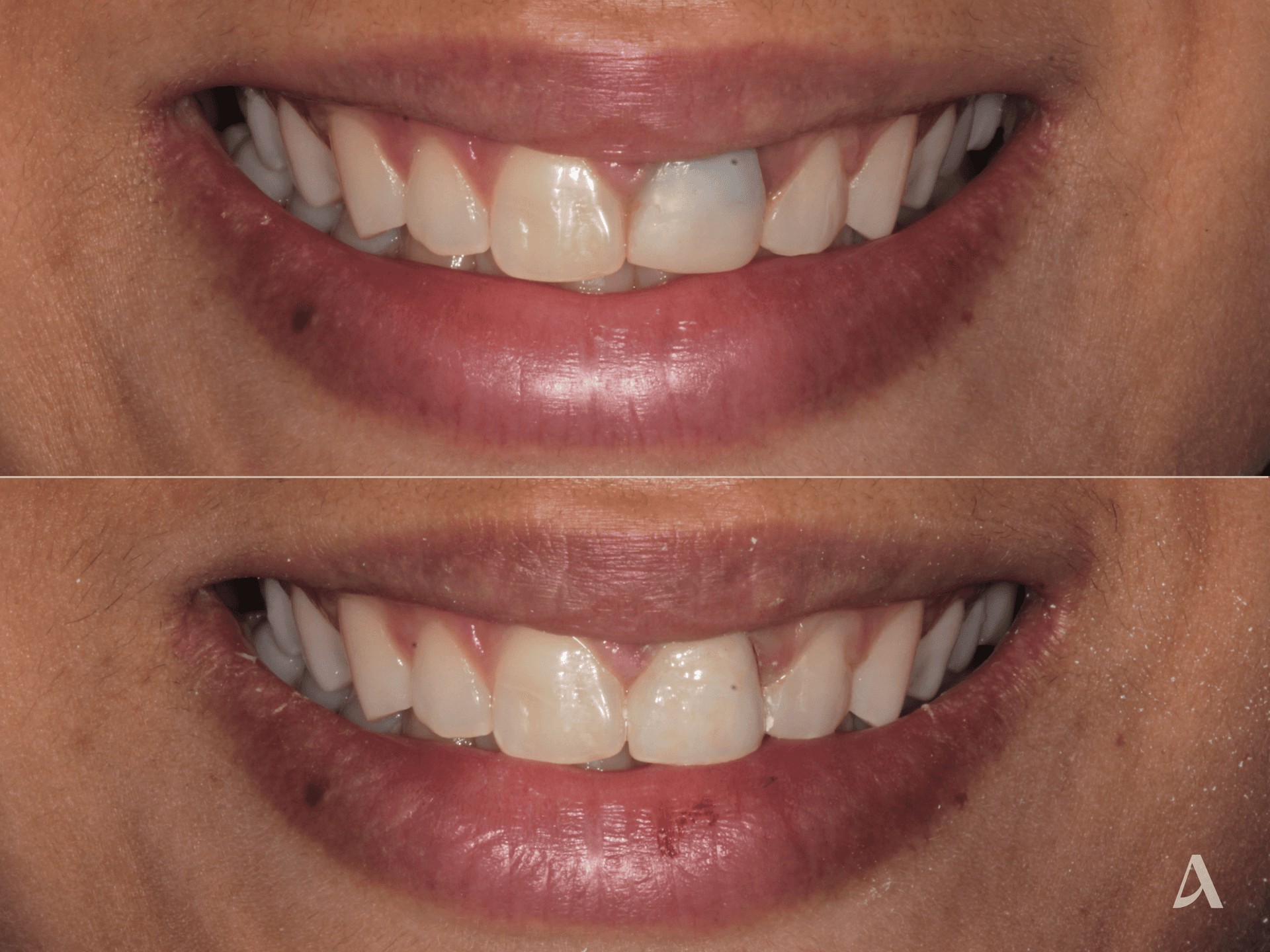 Zirconia Veneers, Crown & Bridge – 3 months – ArtSmiles Gold Coast