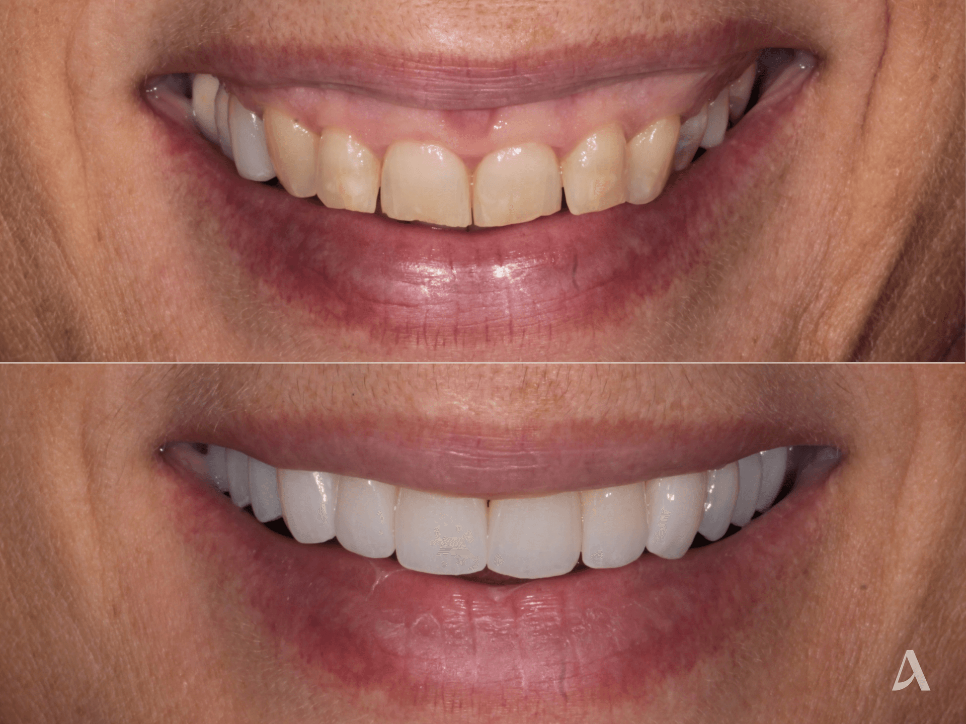 Zirconia Veneers, Gum Recontouring – 3 months – ArtSmiles Gold Coast