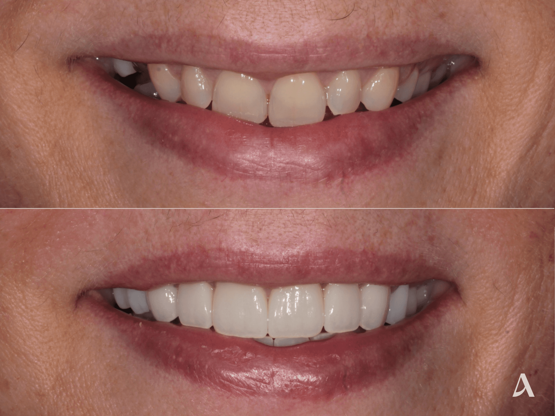 Zirconia Veneers, Implant, Crown & Bridge – 5 months – ArtSmiles Gold Coast