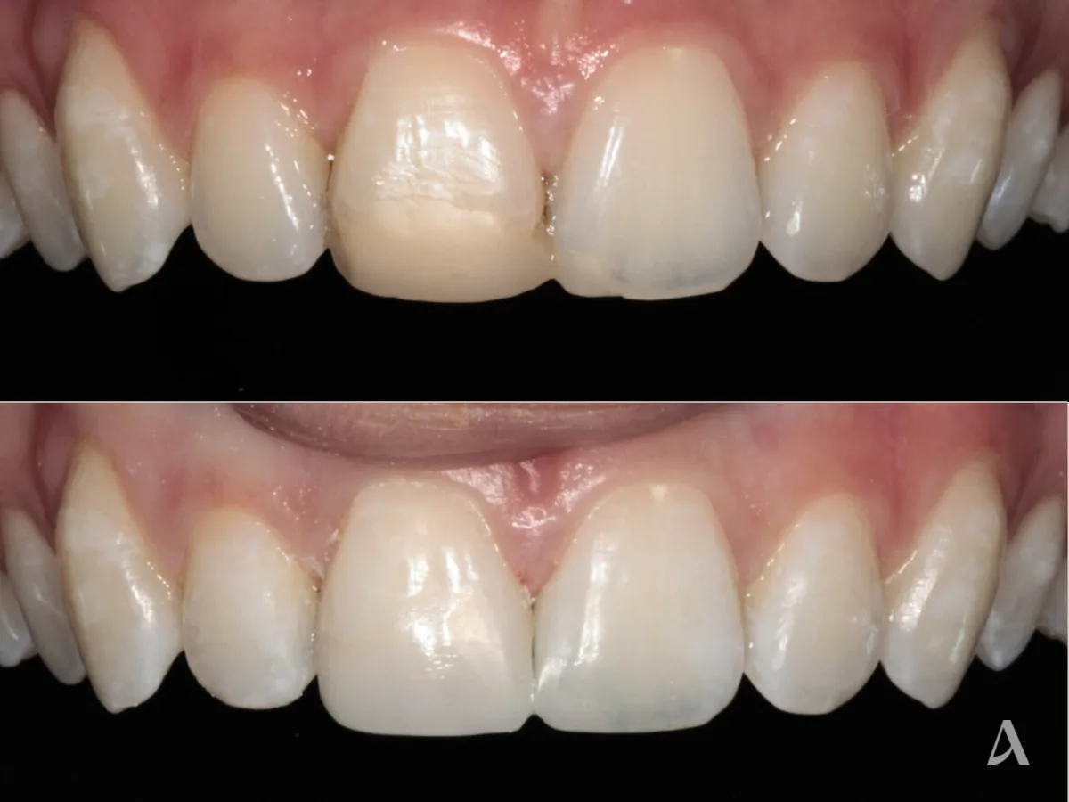 Dental filling before and after – ArtSmiles Gold Coast