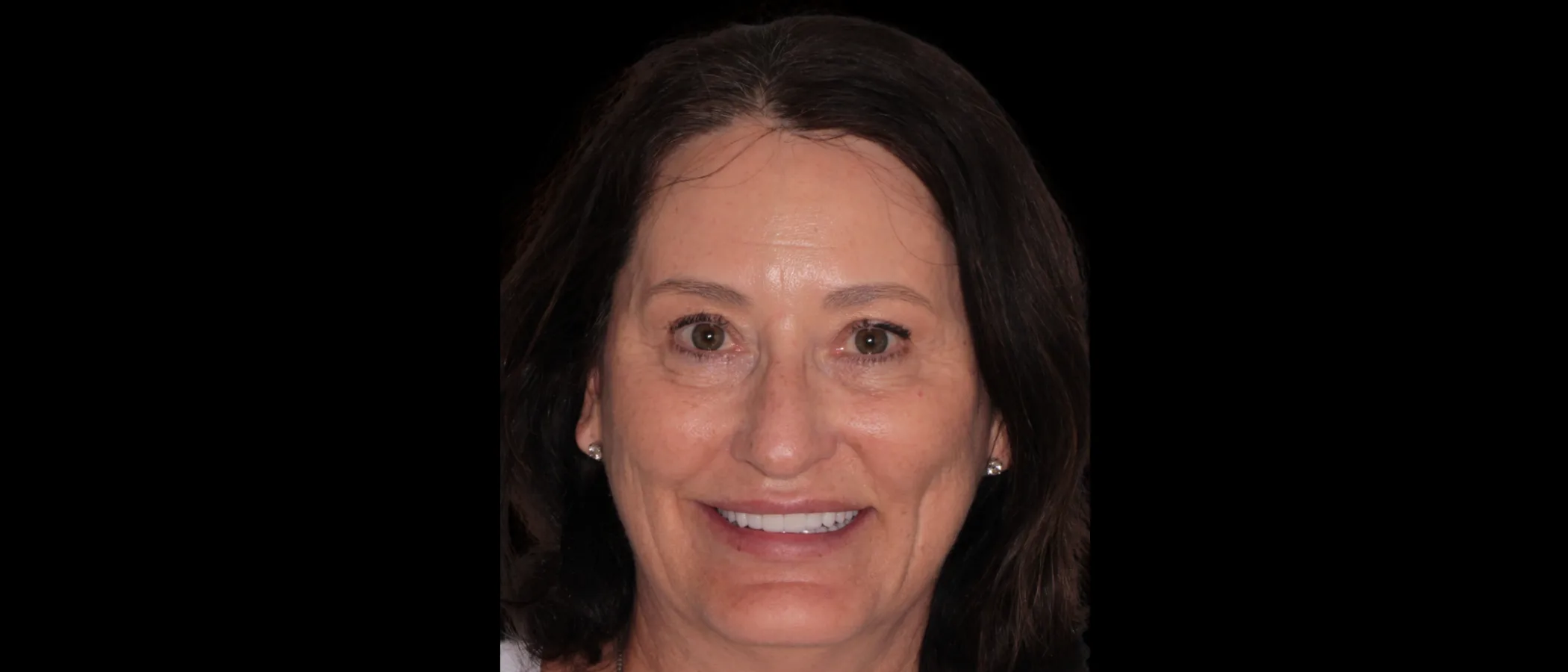 Full Mouth Rehabilitation