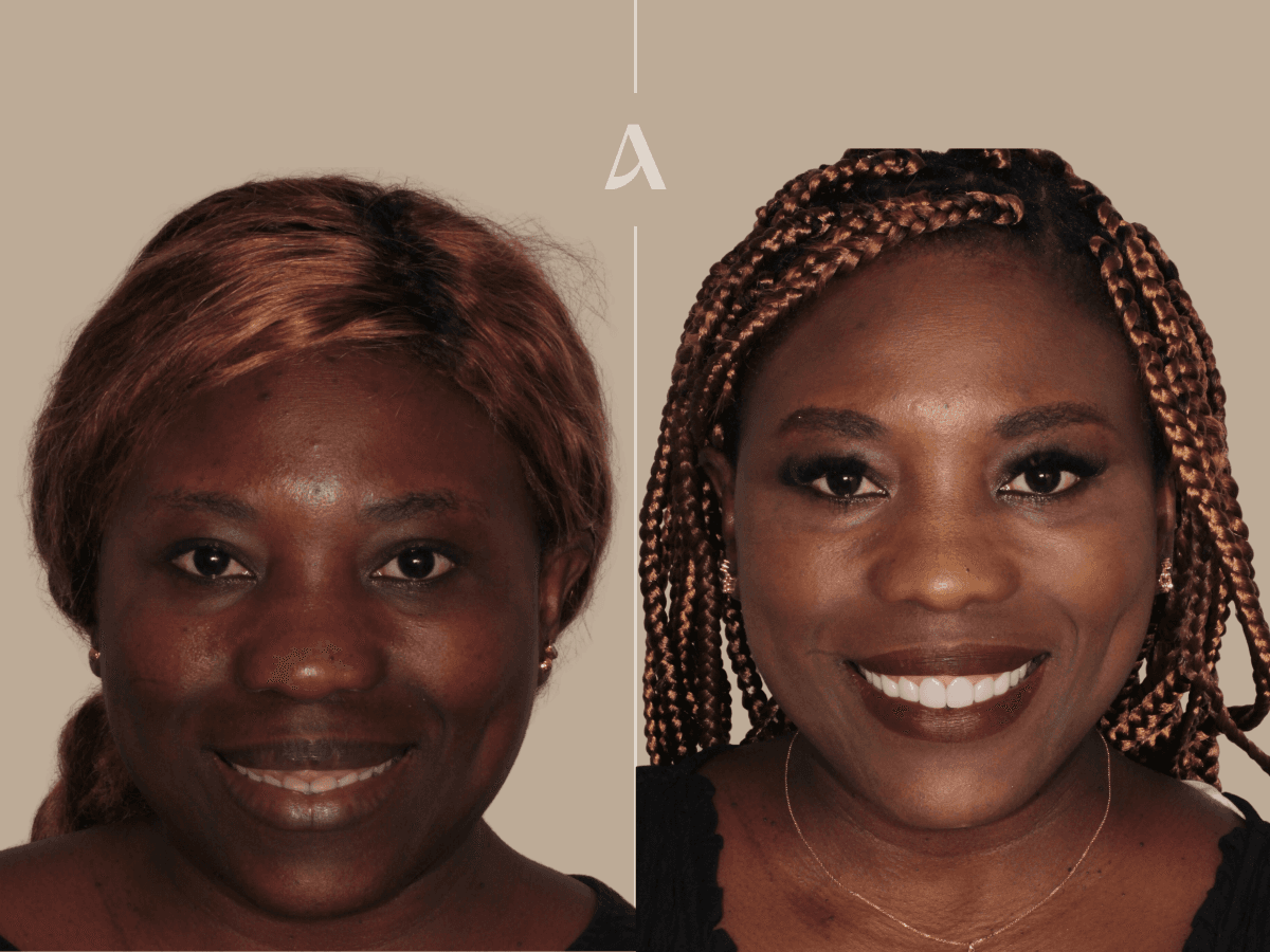 Gum recontouring and porcelain veneers treatment – total procedure time 3 months