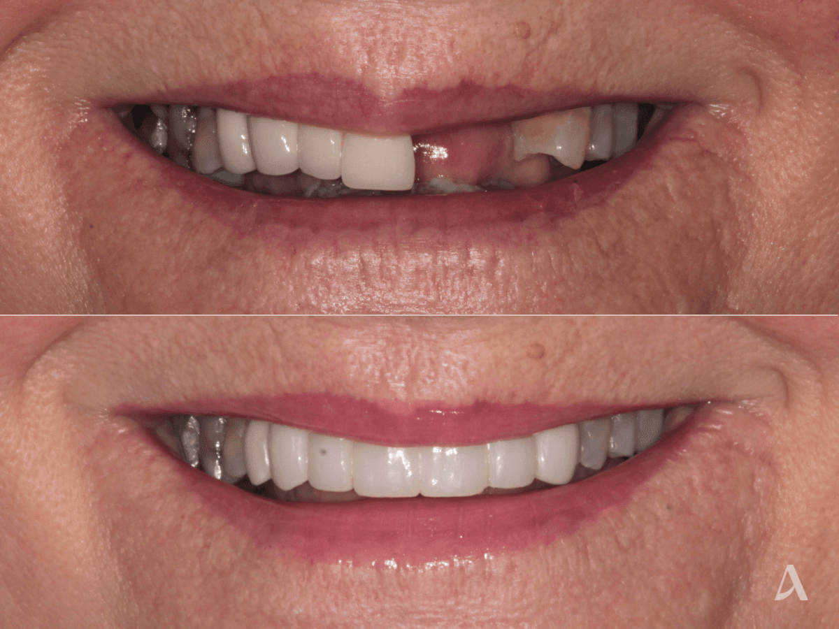 Missing teeth replacement with implant, crown and bridge – ArtSmiles Gold Coast