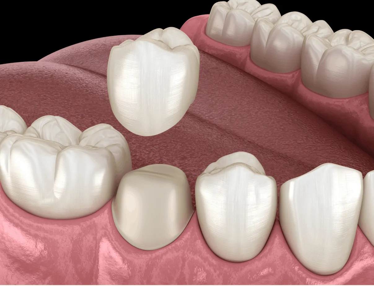 Dental Crown | ArtSmiles Gold Coast Dentists