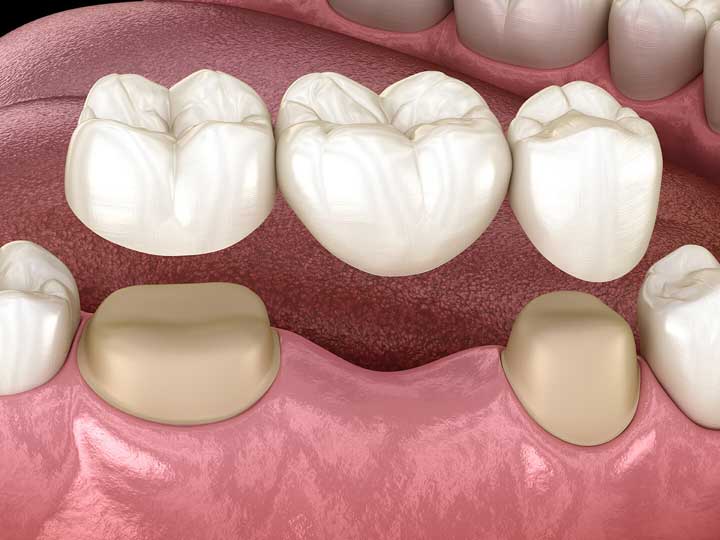 Representation of a Dental bridge dental image