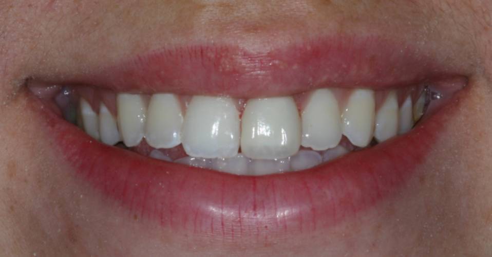 Dental composite veneer