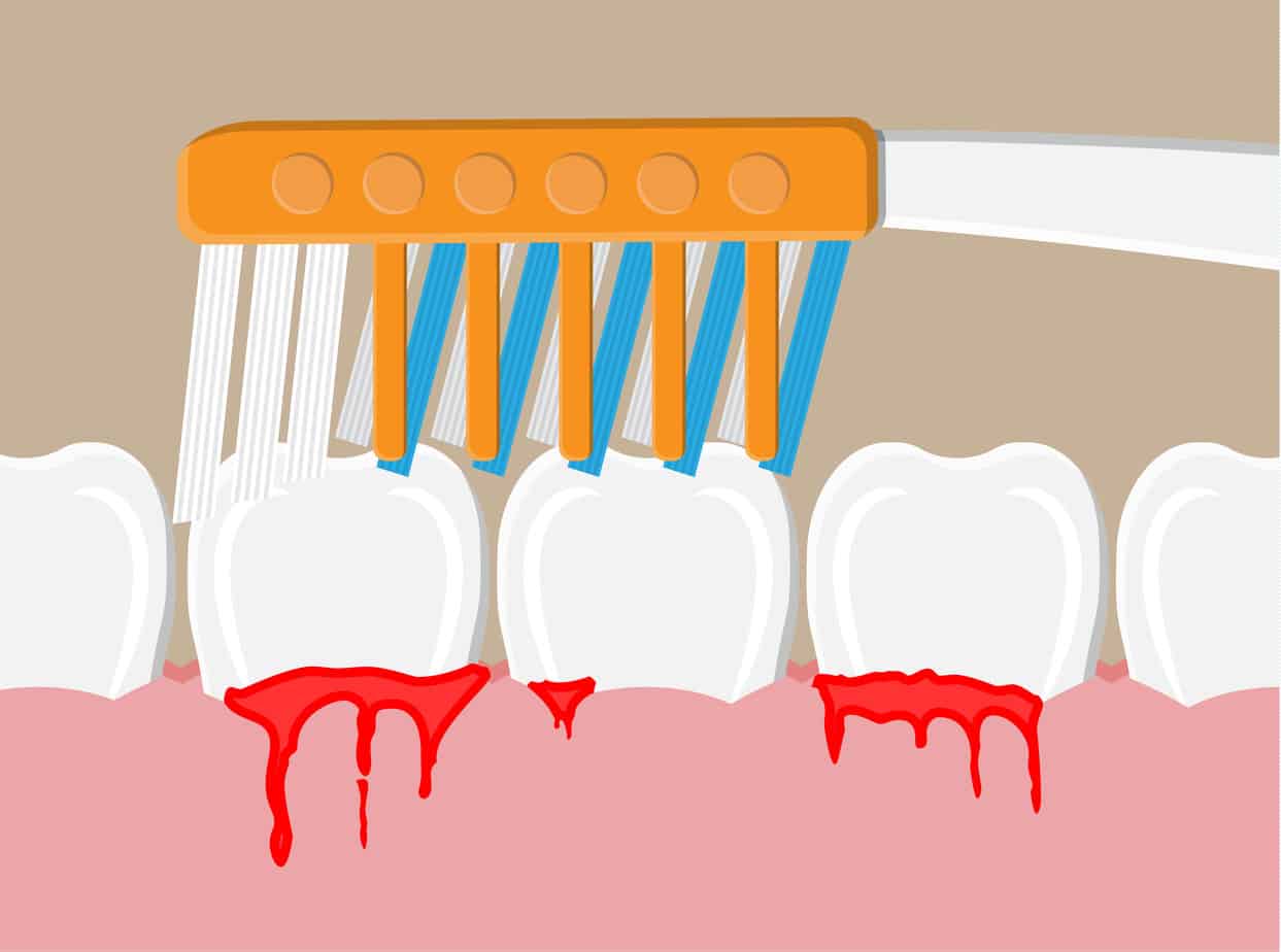 bleeding gum periodontal disease