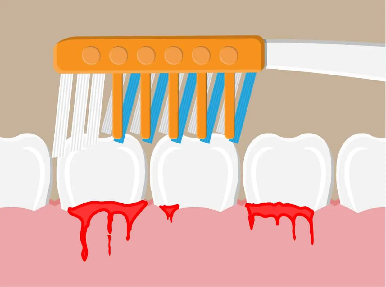Toothbrush cleans teeth. periodontal disease, bleeding gums. Brushing teeth. Dental equipment. Hygiene and oralcare. Vector illustration in flat style