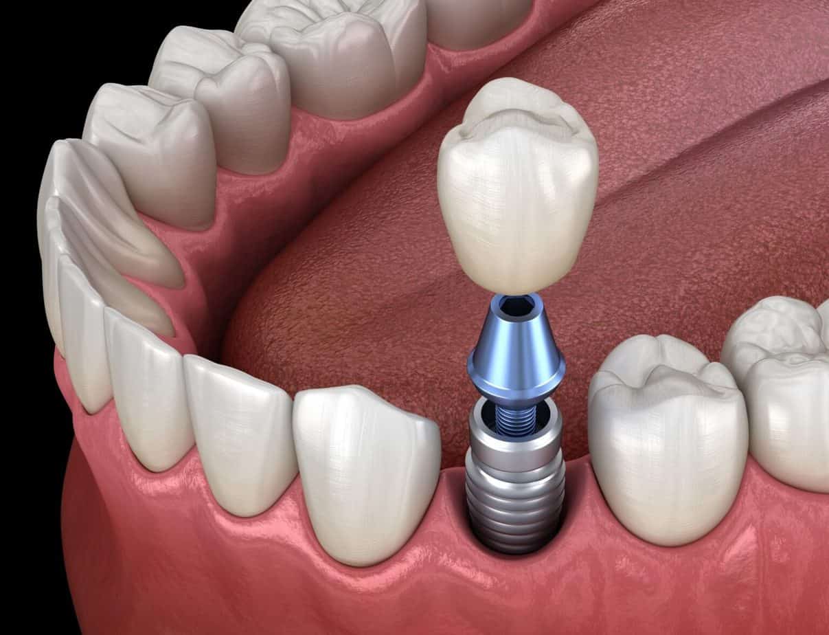 Dental Implants Gold Coast Costs, Options & Tooth Implant FAQs