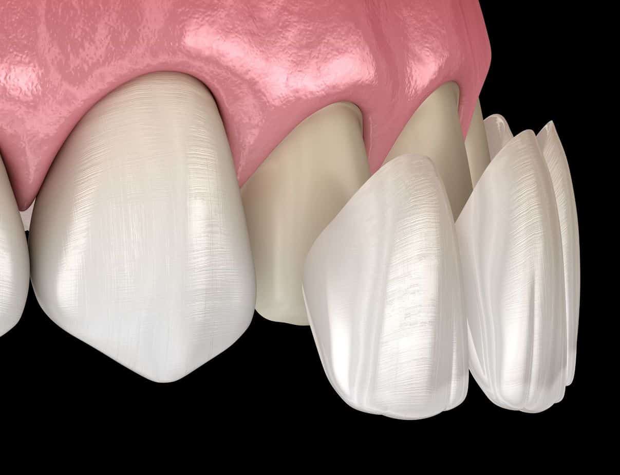 dental veneers procedure digital image