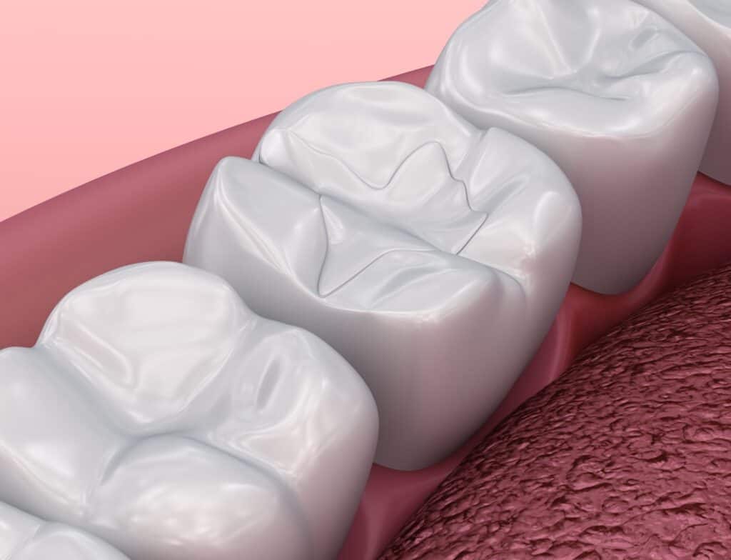 digital image of dental fillings cosmetic procedure