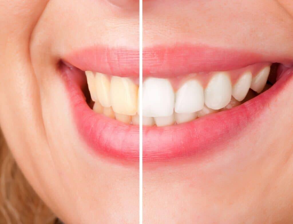 before and after teeth whitening