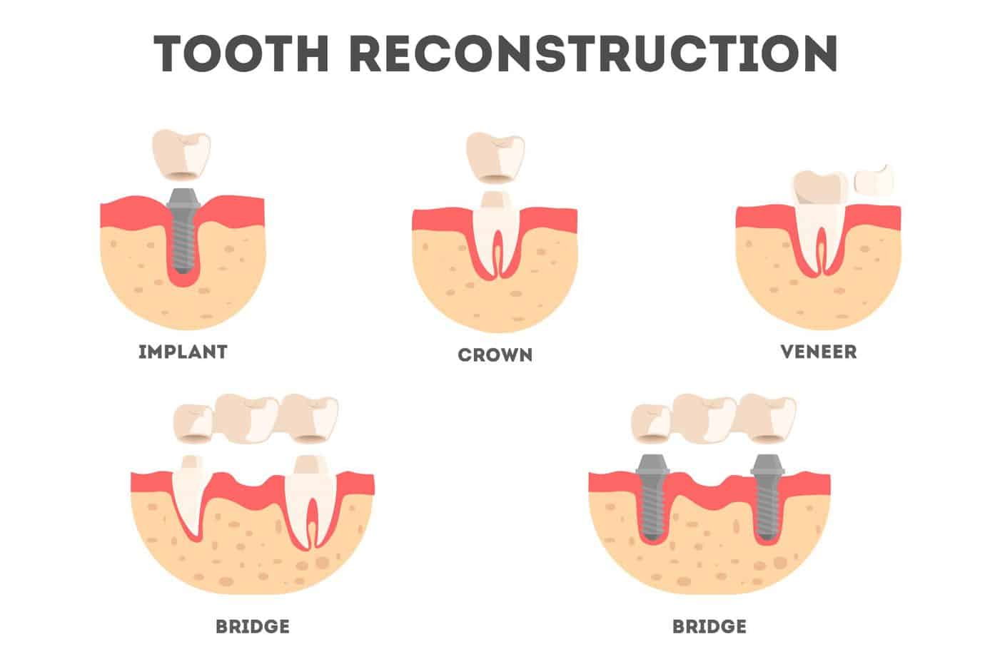 dental crown ve