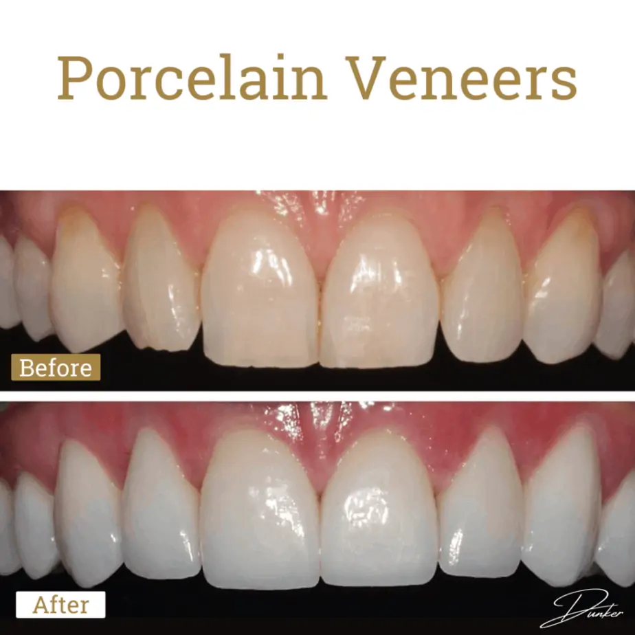 Porcelain Veneers before and after