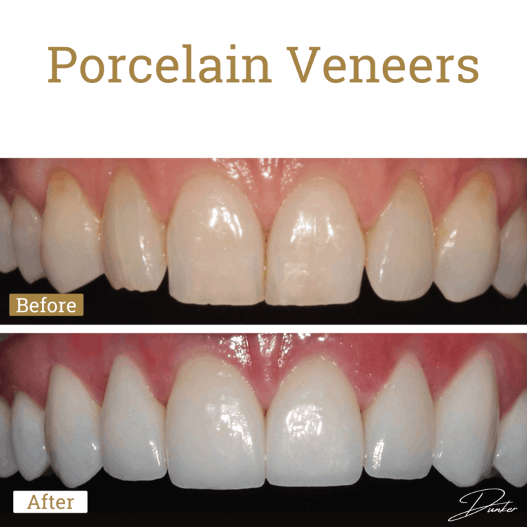 Veneers Gold Coast | Porcelain & Composite Veneers | Artsmiles