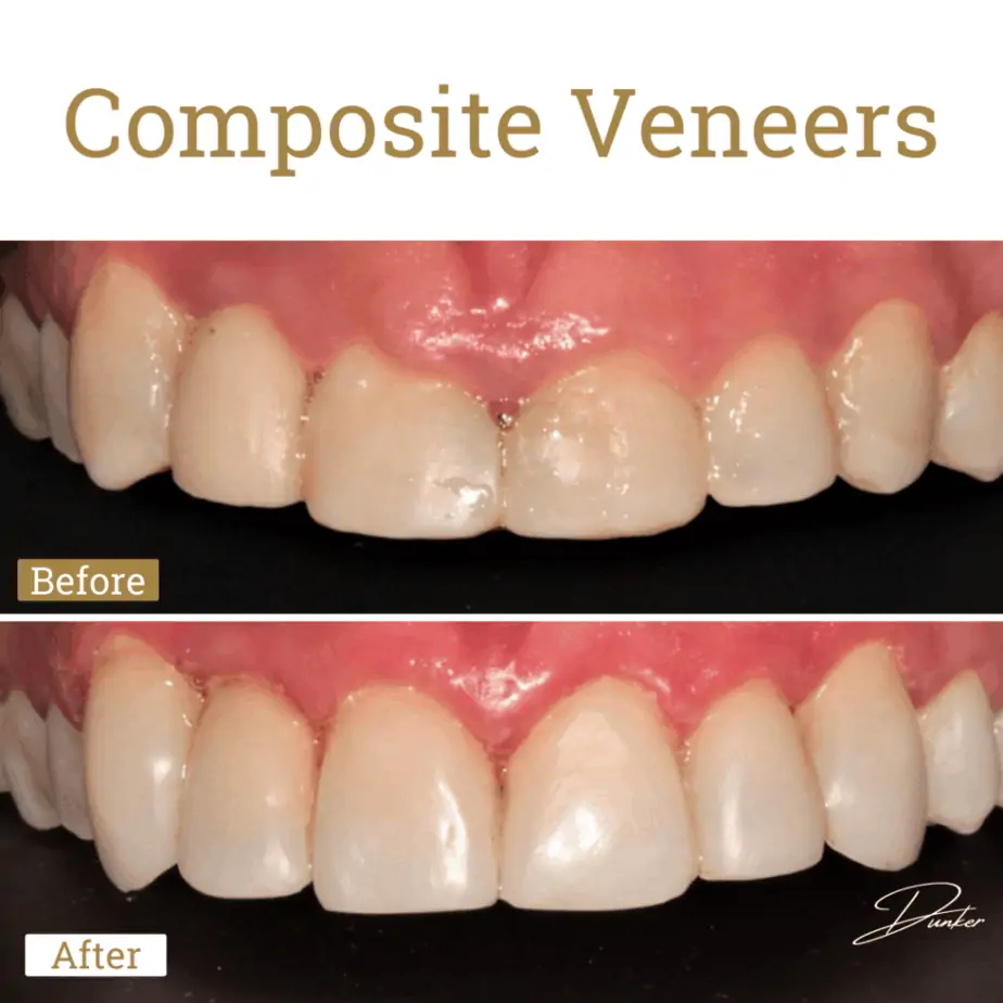 Composite Veneers before and after
