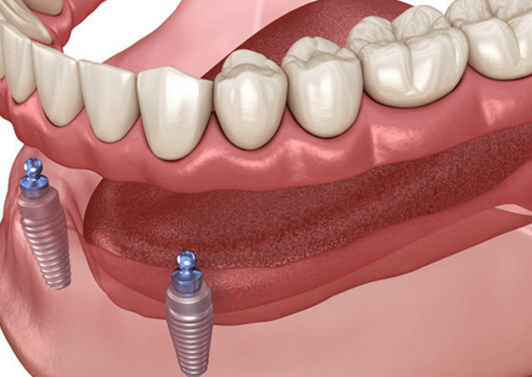 Implant Overdentures by Artsmiles Dental Implants Southport