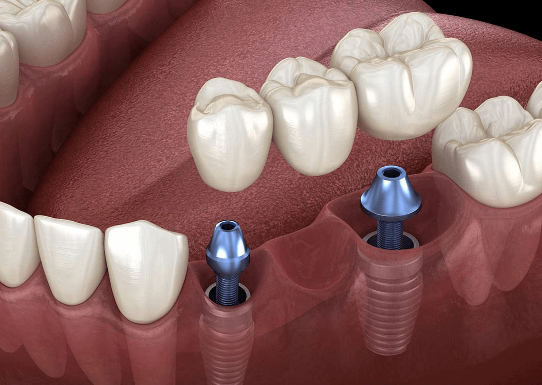 Digital Image of Fixed Implant Bridges