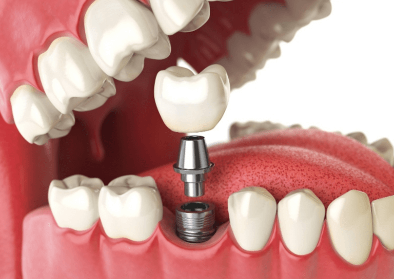Single-Stage Dental Implant by Artsmiles Dental Procedures Gold Coast