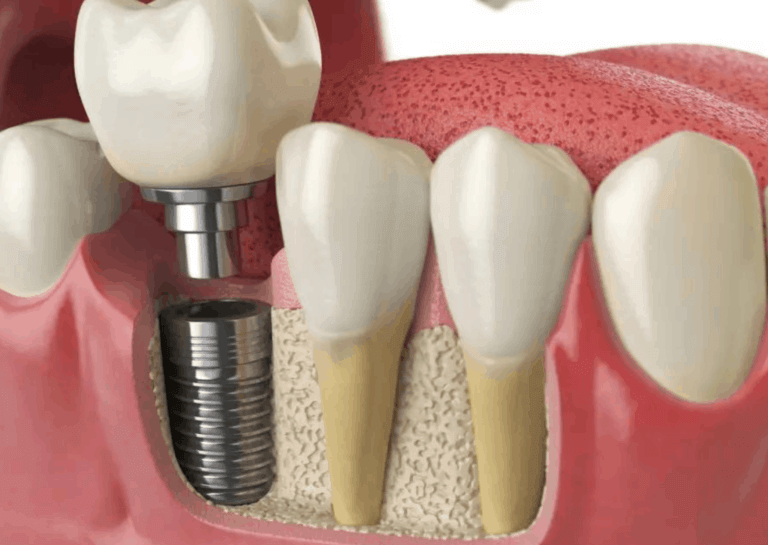 Digital Image of Two Stage Dental Implant
