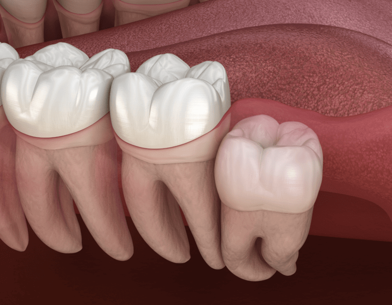 Wisdom Teeth Removal | Gold Coast Dentist | ArtSmiles 4 Digital reproduction of wisdom teeth