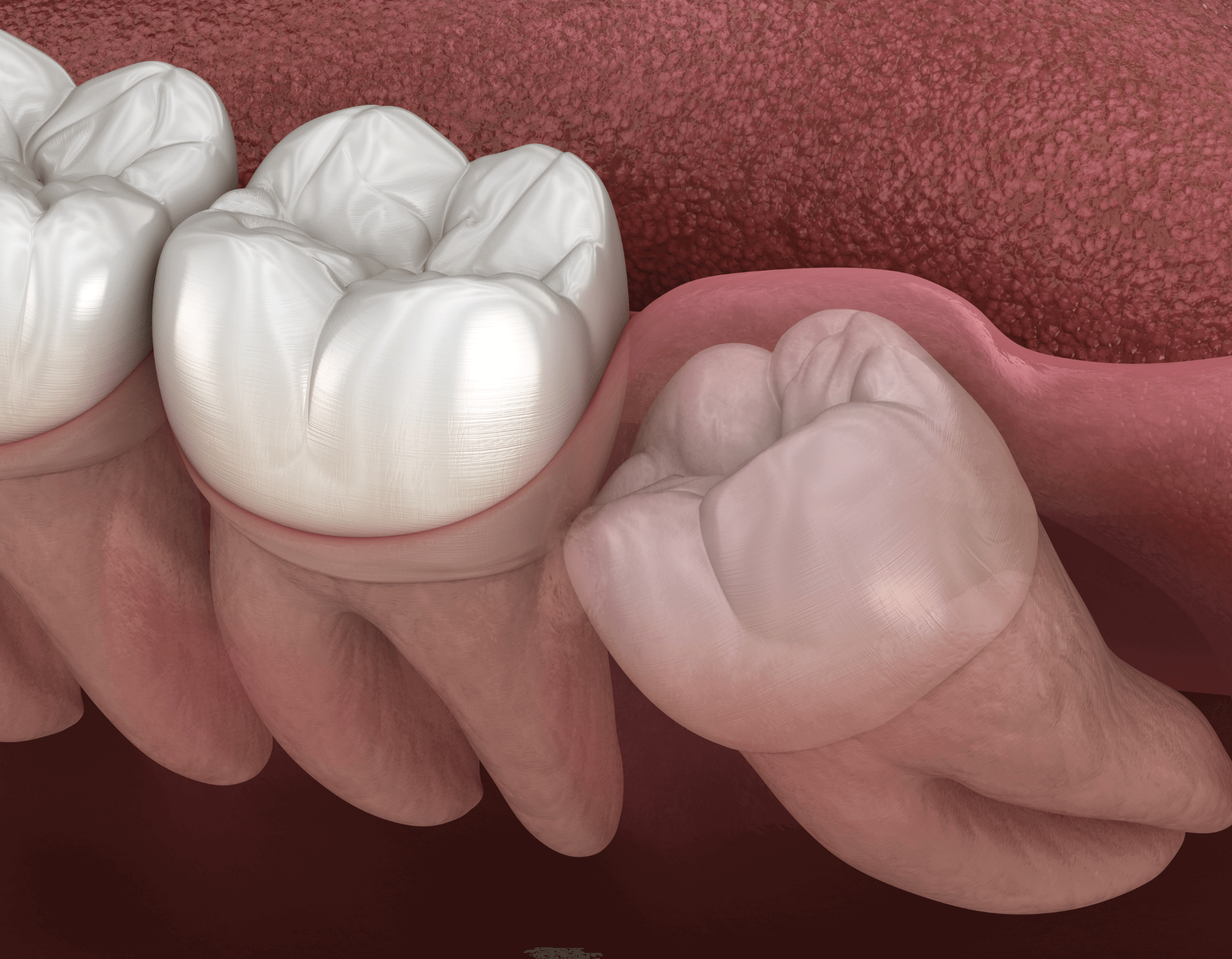 Digital reproduction of impacted wisdom tooth