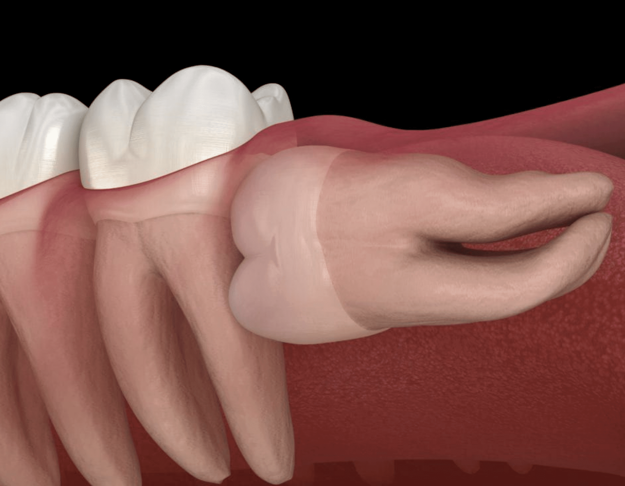 Digital reproduction of highly impacted wisdom teeth