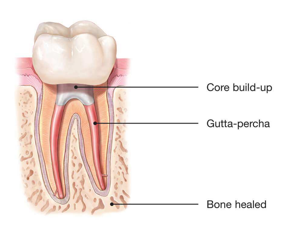 Draw of a tooth with components of Root Canal Therapy