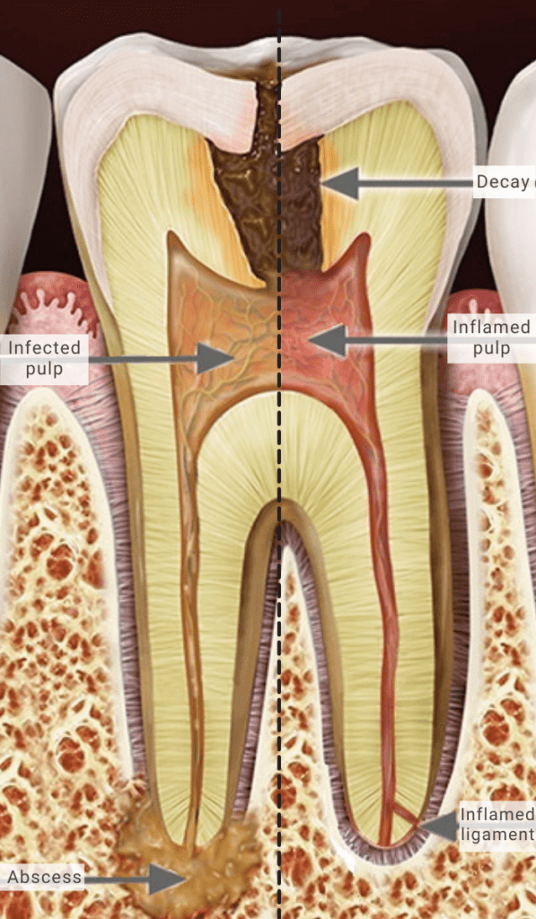 Root Canal Gold Coast | Endodontic Treatment | ArtSmiles Dental 1 Root Canal Southport