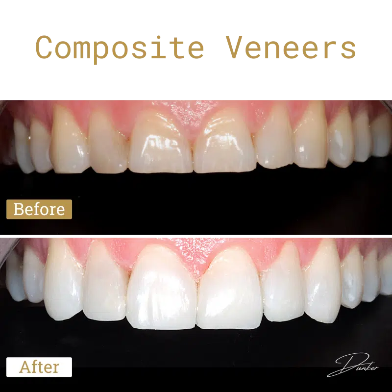 Before and after and the text composite veneers