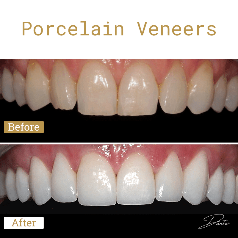 Before and after and the text porcelain veneers